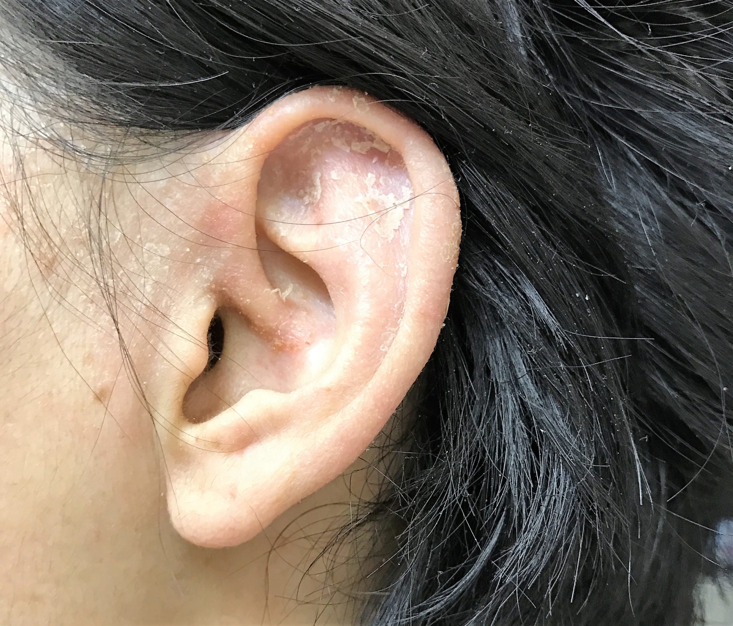 耳の湿疹 左 - ヒフ・ファイター